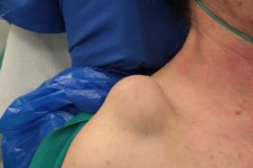 ganglion ac.jpg