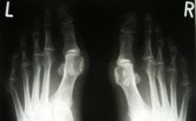 hallux.jpg