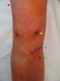 ACL-blizny-schemat-150.jpg