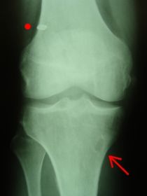 acl-postop-rtg-ap.jpg