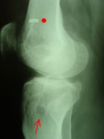 acl-postop-rtg-boczne.jpg